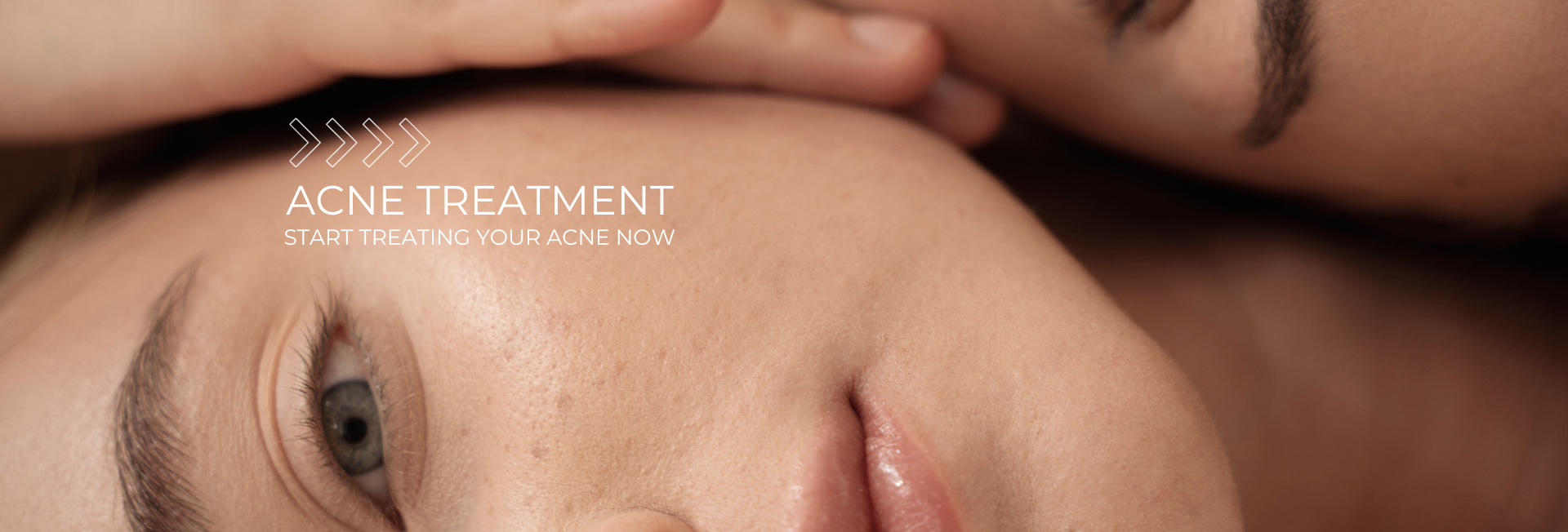 Acne Treatment